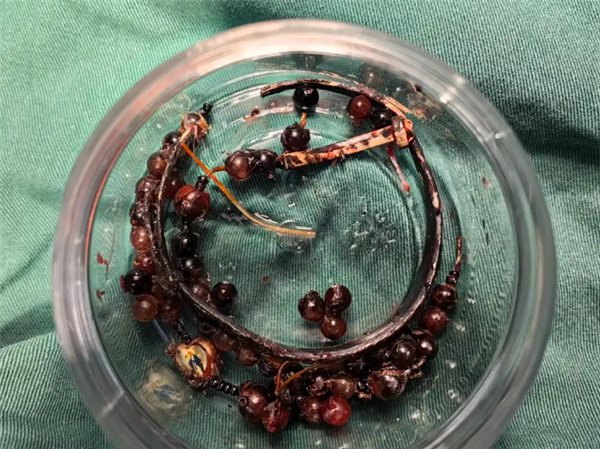 33岁女子戴手镯10年不摘:长胖后嵌进肉里严重感染