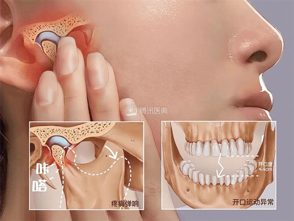 00后女生一觉醒来无法张嘴：确诊“TM D”