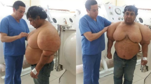 深潜后上升太快 秘鲁潜水员身体肿成大力水手：太痛苦！