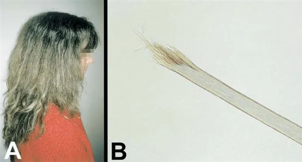 头发开叉其实是种病,很多人忽视了!3步就能改善