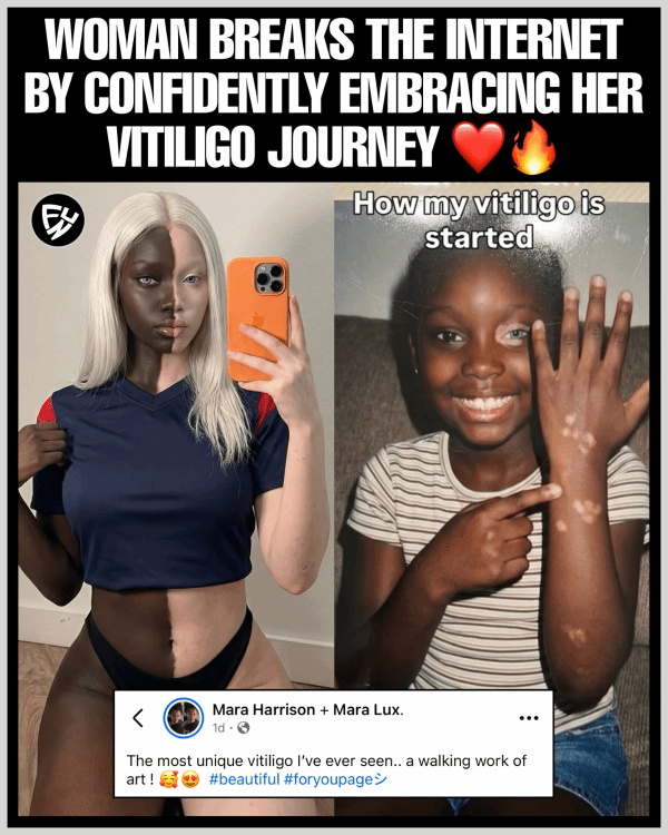 一个患有白癜风的美国女孩火了 网友:还真能这么均匀
