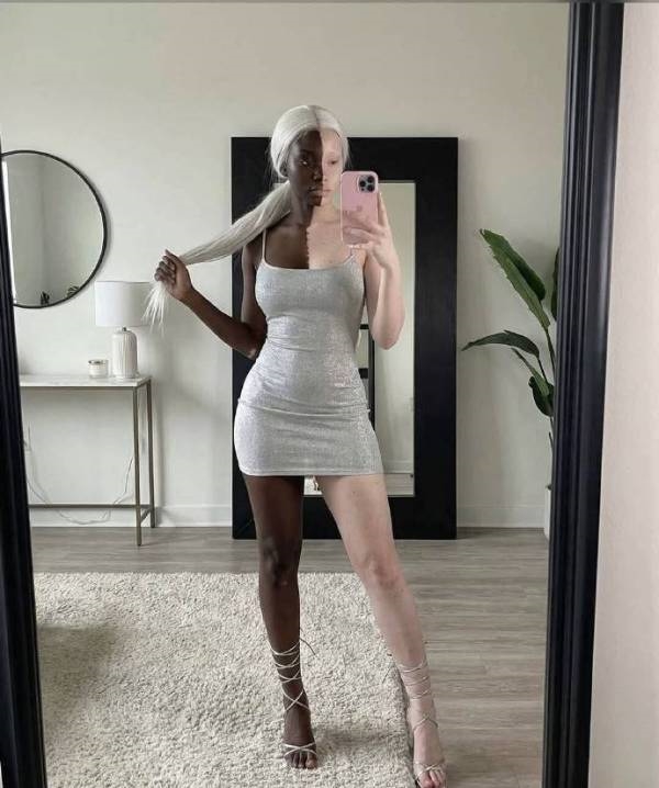 一个患有白癜风的美国女孩火了 网友:还真能这么均匀