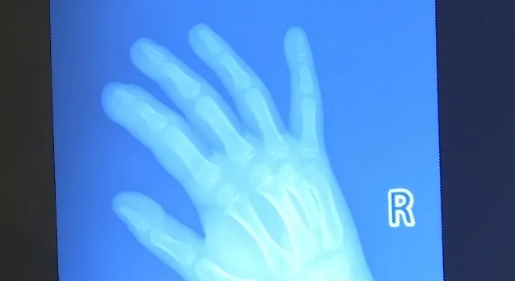 湖南5岁男童啃手致重度感染侵骨 医生:警惕诱发脓毒血症