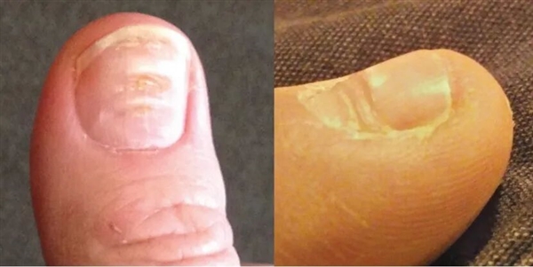 指甲为什么总从这个地方断开 是缺钙了吗