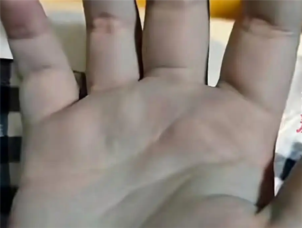 一家人吃自制牛瘪火锅中毒双手变蓝 加入一种不知名蔬菜